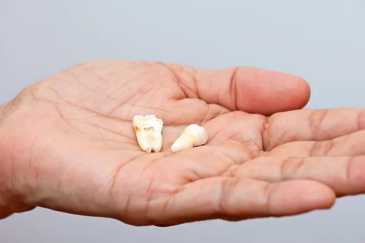Two extracted teeth resting in an open human palm against a plain light grey background.